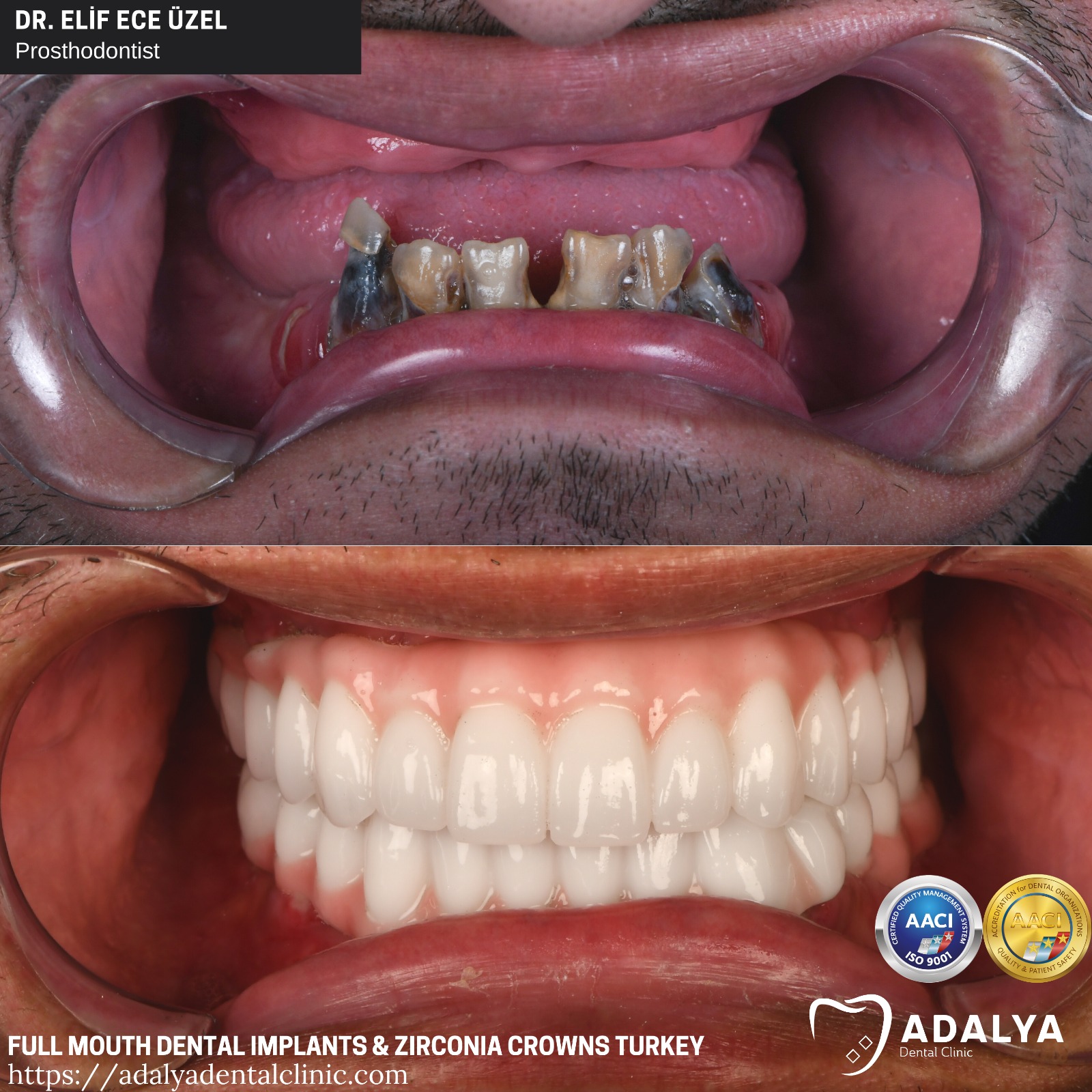 turkey teeth before after full mouth dental implants