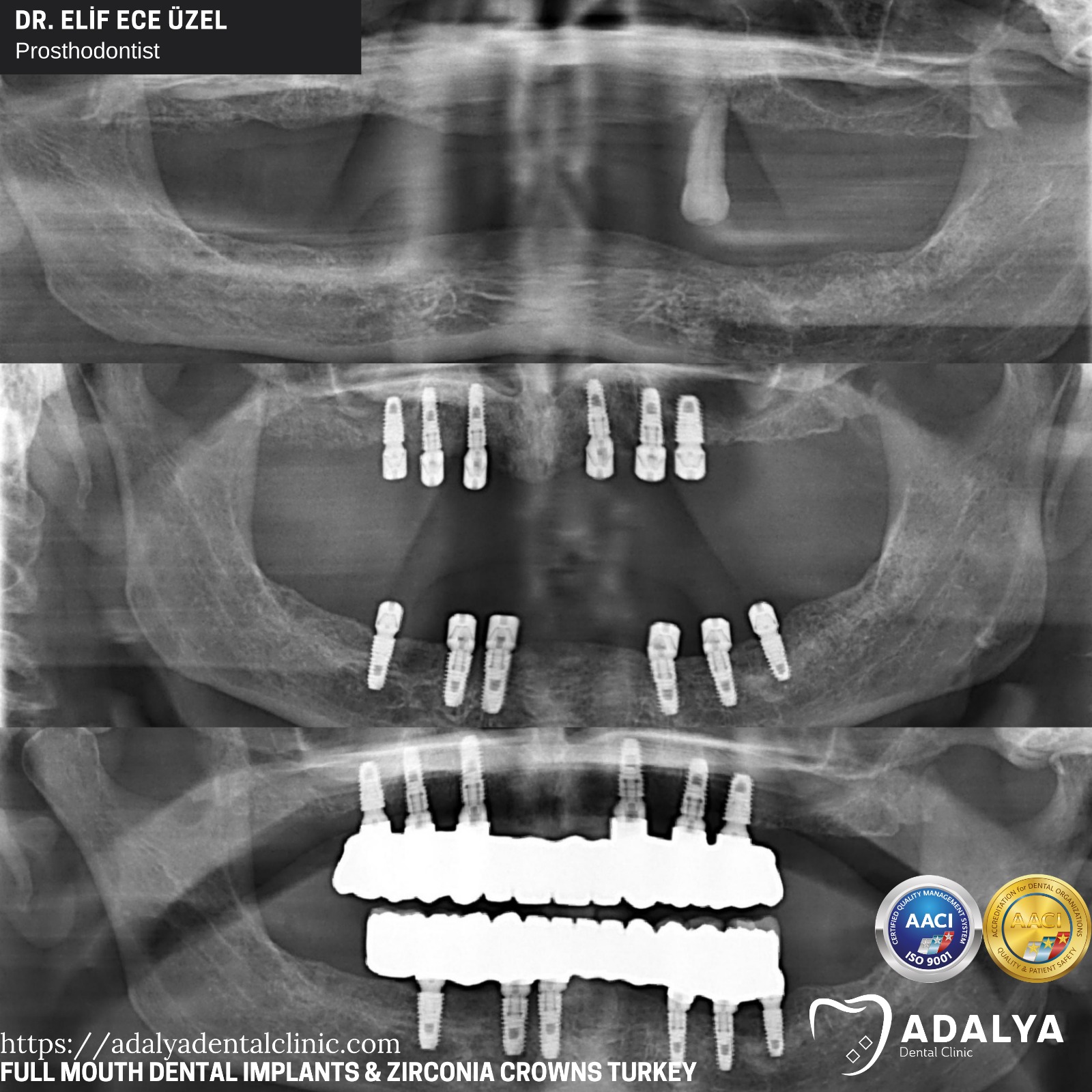 full set of tooth implants turkey package deals price reviews antalya