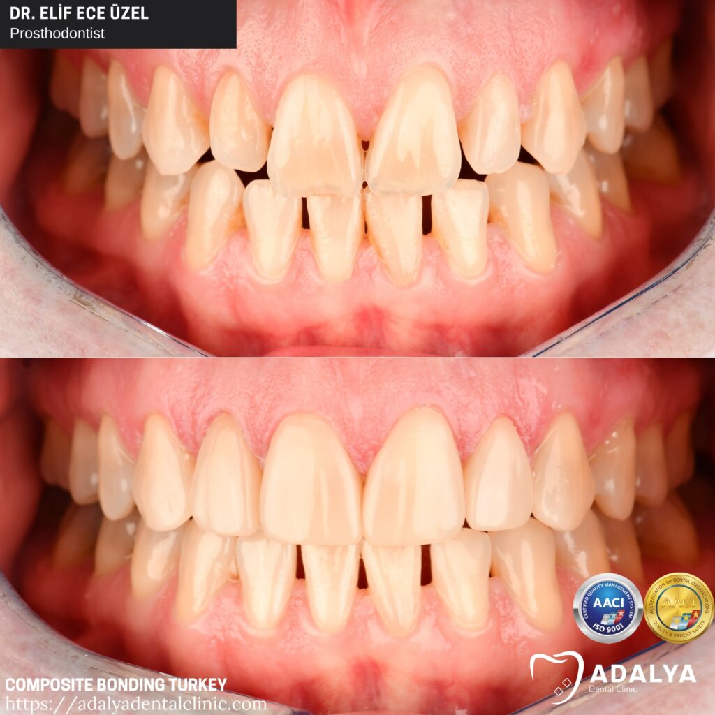 Composietverlijming in Turkije kosten, voordelen, prijs Antalya Veneers