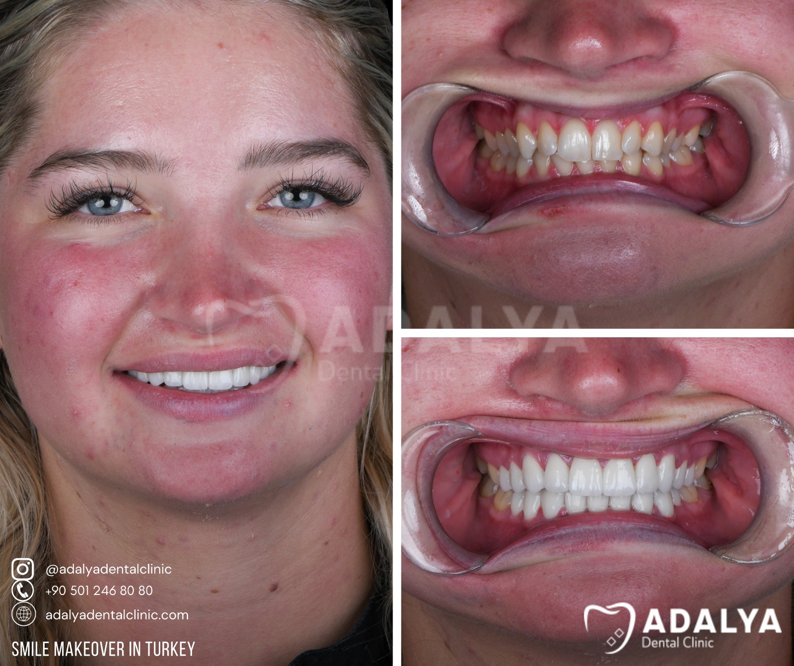 smile makeover turkey prices antalya reviews cost