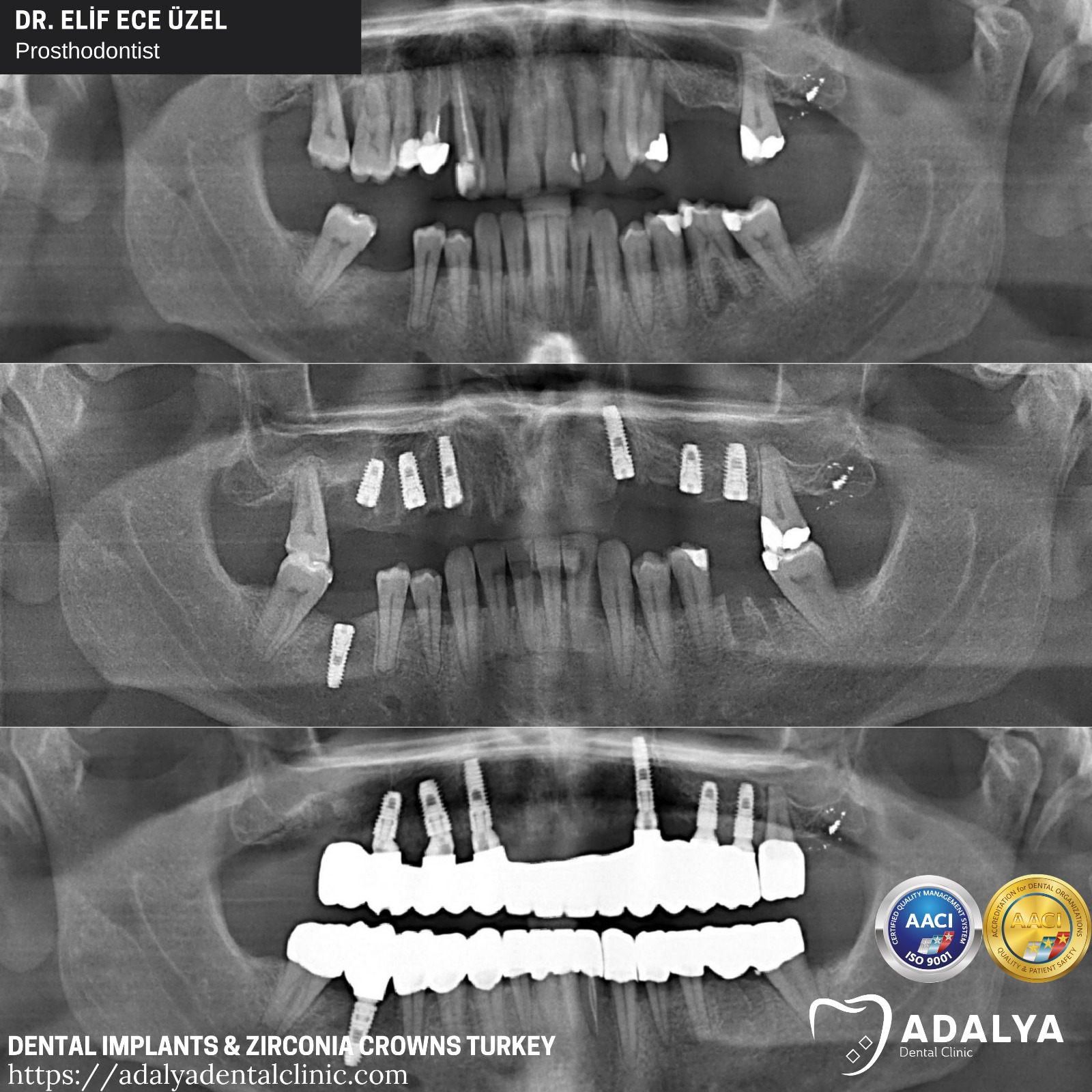 teeth implants antalya turkey price packgaes istanbul