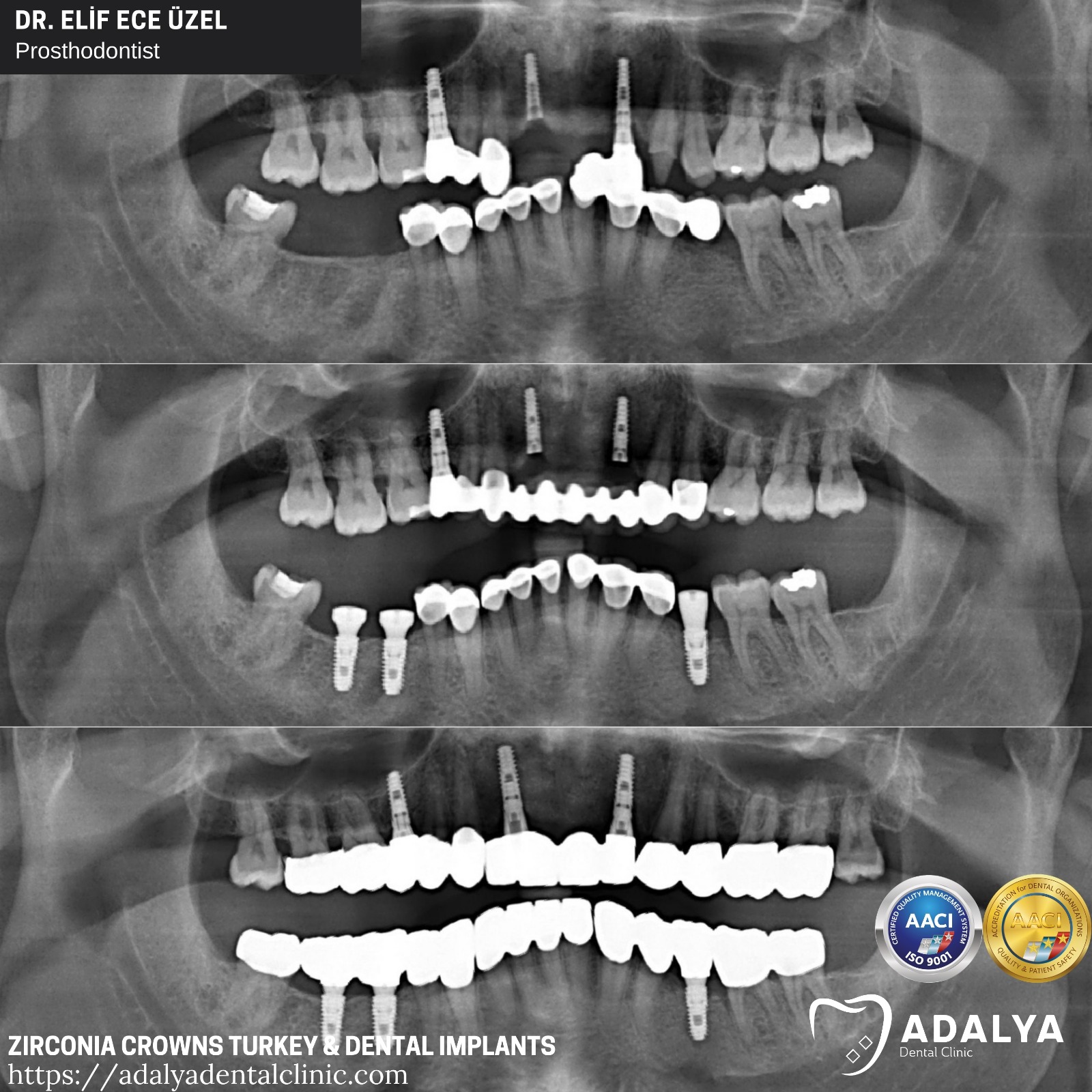 teeth implants turkey dental centre antalya price