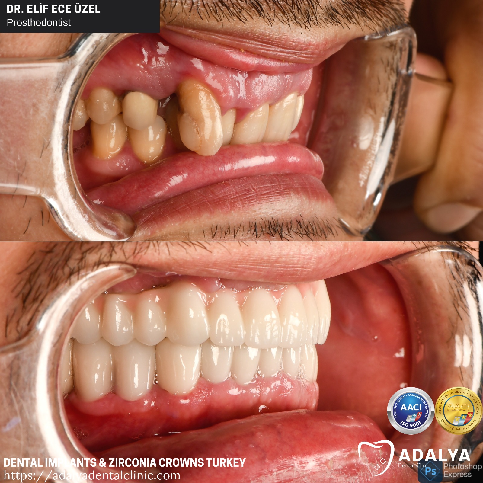 Truthahnzähne vorher nachher Zahnimplantate in Antalya