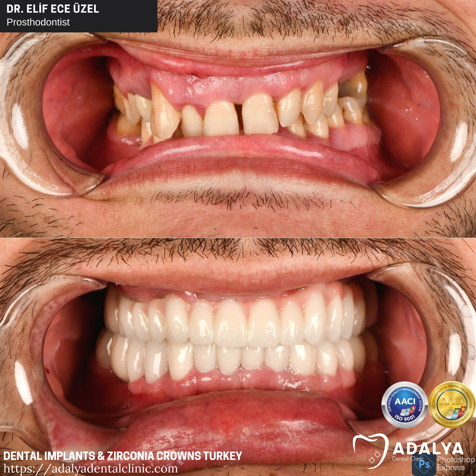 turkey teeth before after dental implants antalya