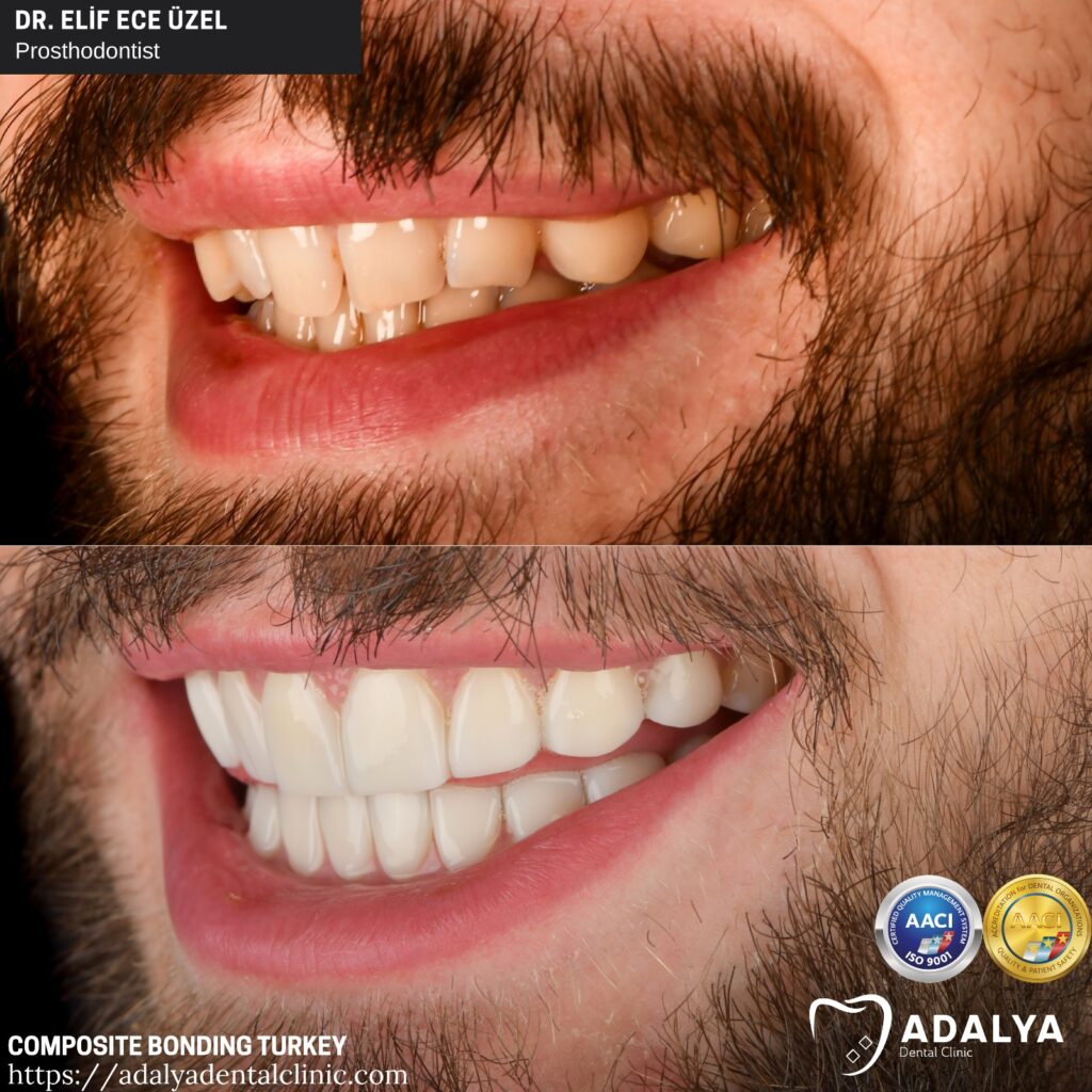 Composite Bonding in Turkey Cost, Advantages, Price Antalya Veneers
