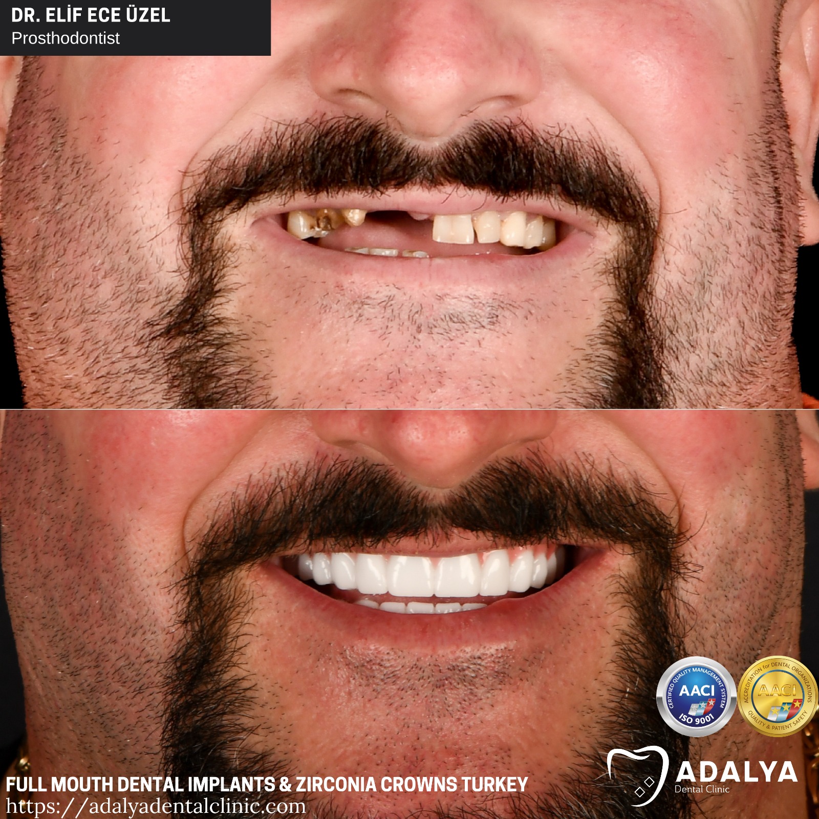 smile turkey all on 8 full mouth dental implants antalya price