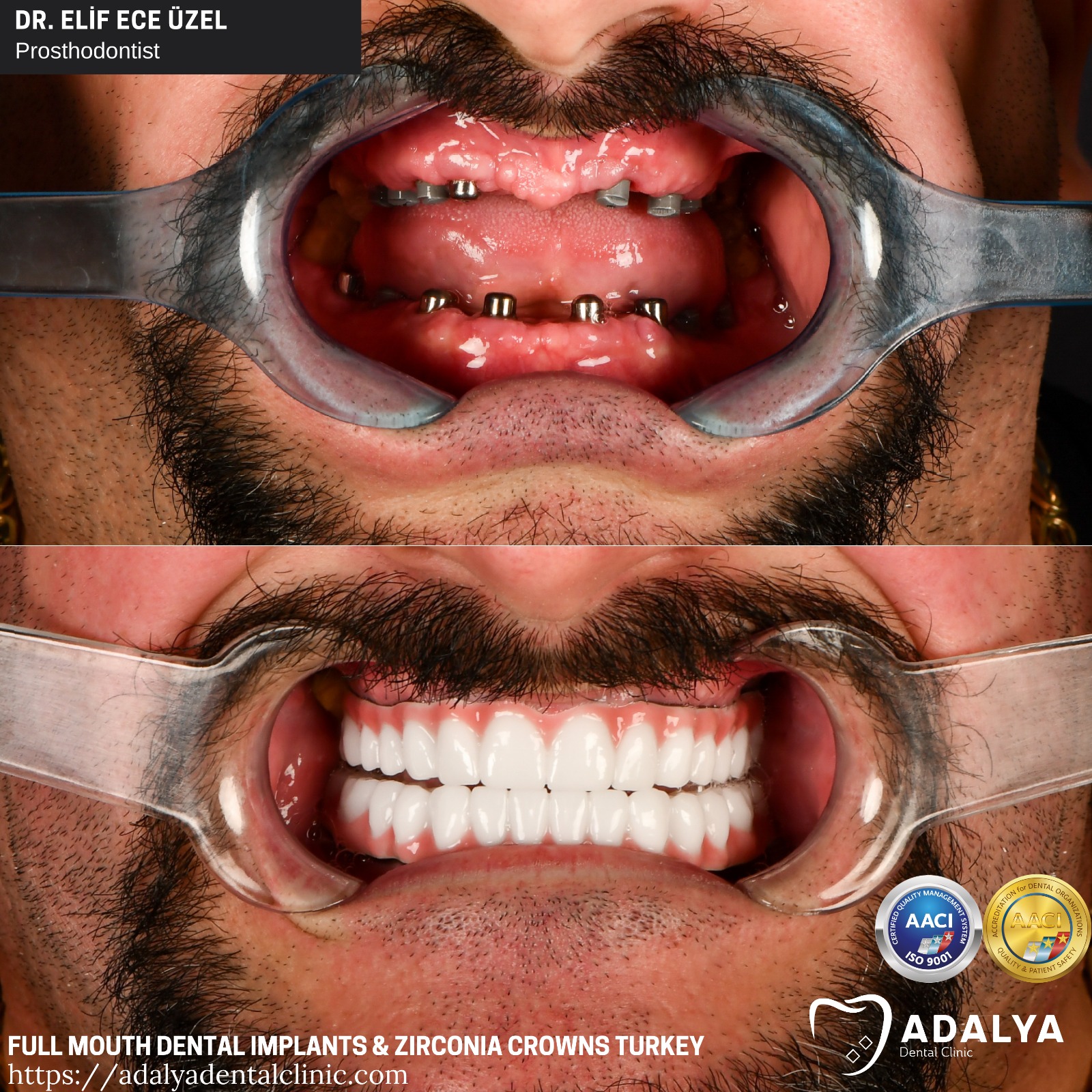 smile turkey all on 8 full mouth dental implants price antalya