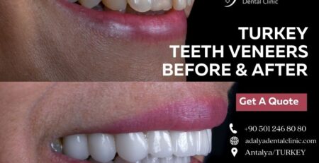 turkey teeth veneers before and after