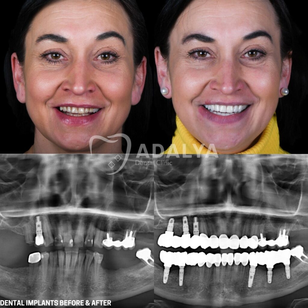 implants containing both glucose oxidase and catalase,... Dental Implants Before and After: Pictures & All Guideline