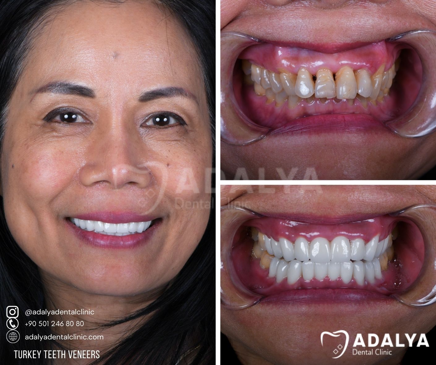 veneer cost per tooth turkey