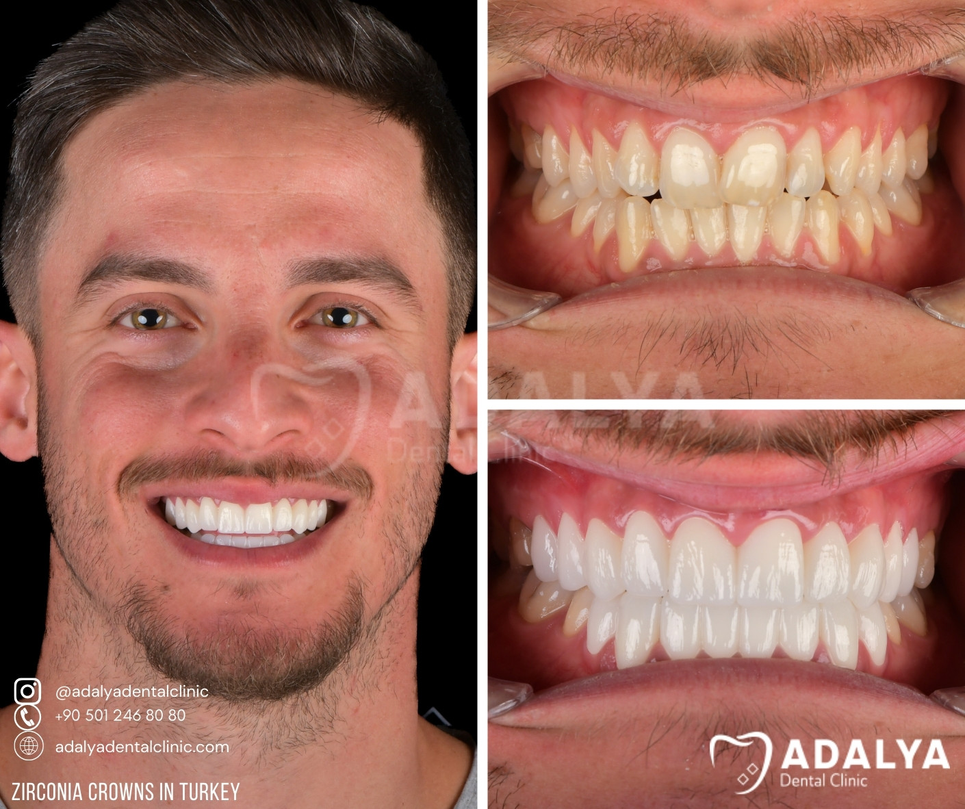 antalya dentist prices turkey teeth clinic