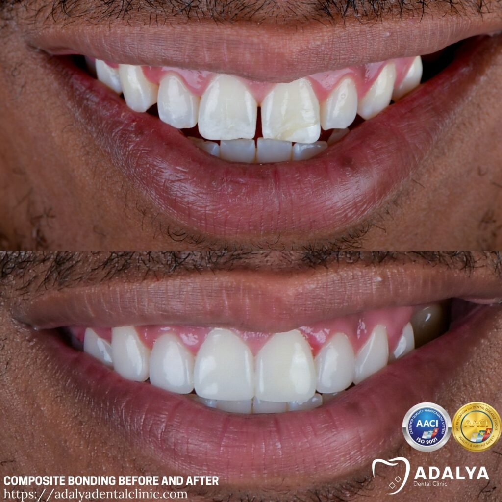 Composite Bonding Before And After Adalya Dental Clinic Composite Bonding Before And After Adalya Dental Clinic