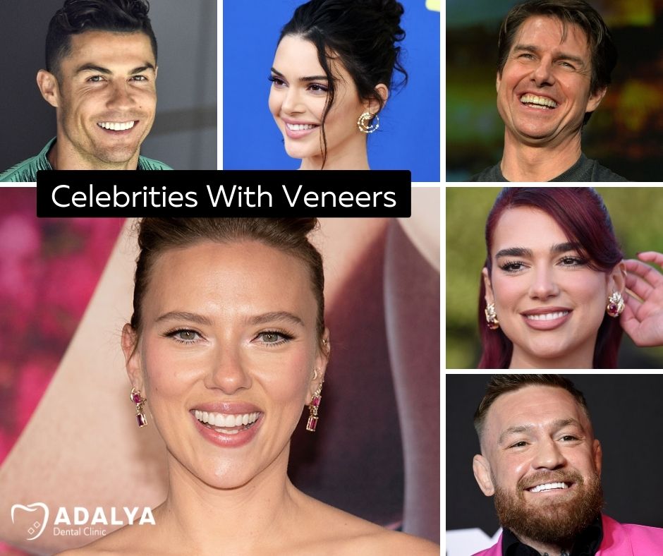 celebrities with veneers