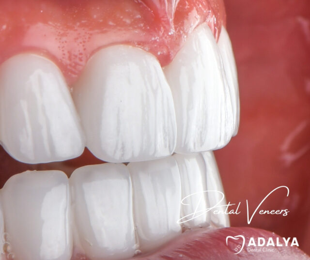 celebrity-veneer-dentist celebrity veneer dentist
