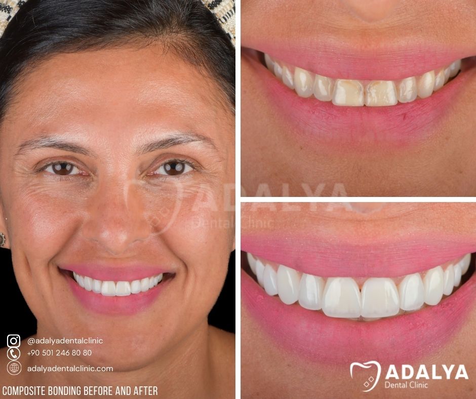 composite bonding united kingdom before after