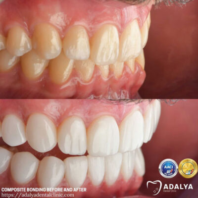 Composite Bonding Before and After - Adalya Dental Clinic