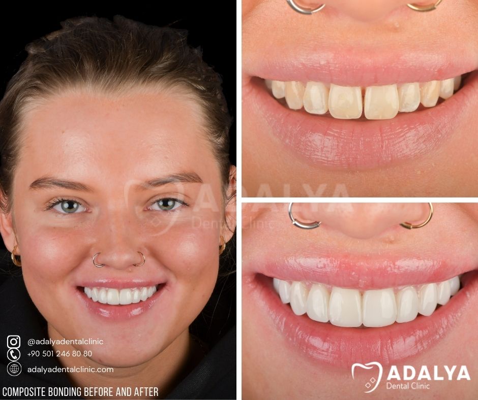 teeth bonding united kingdom before after