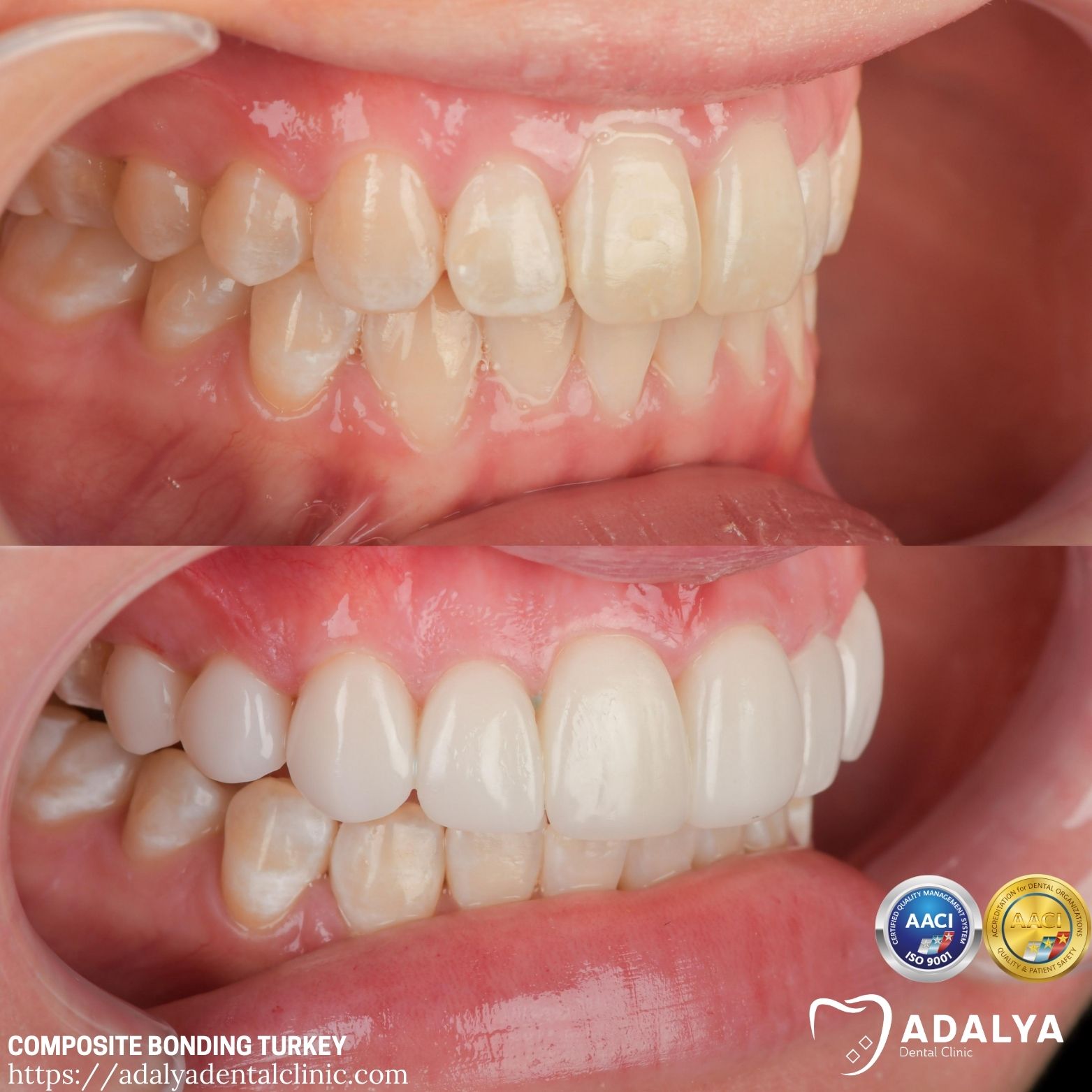 the uk dental bonding before and after