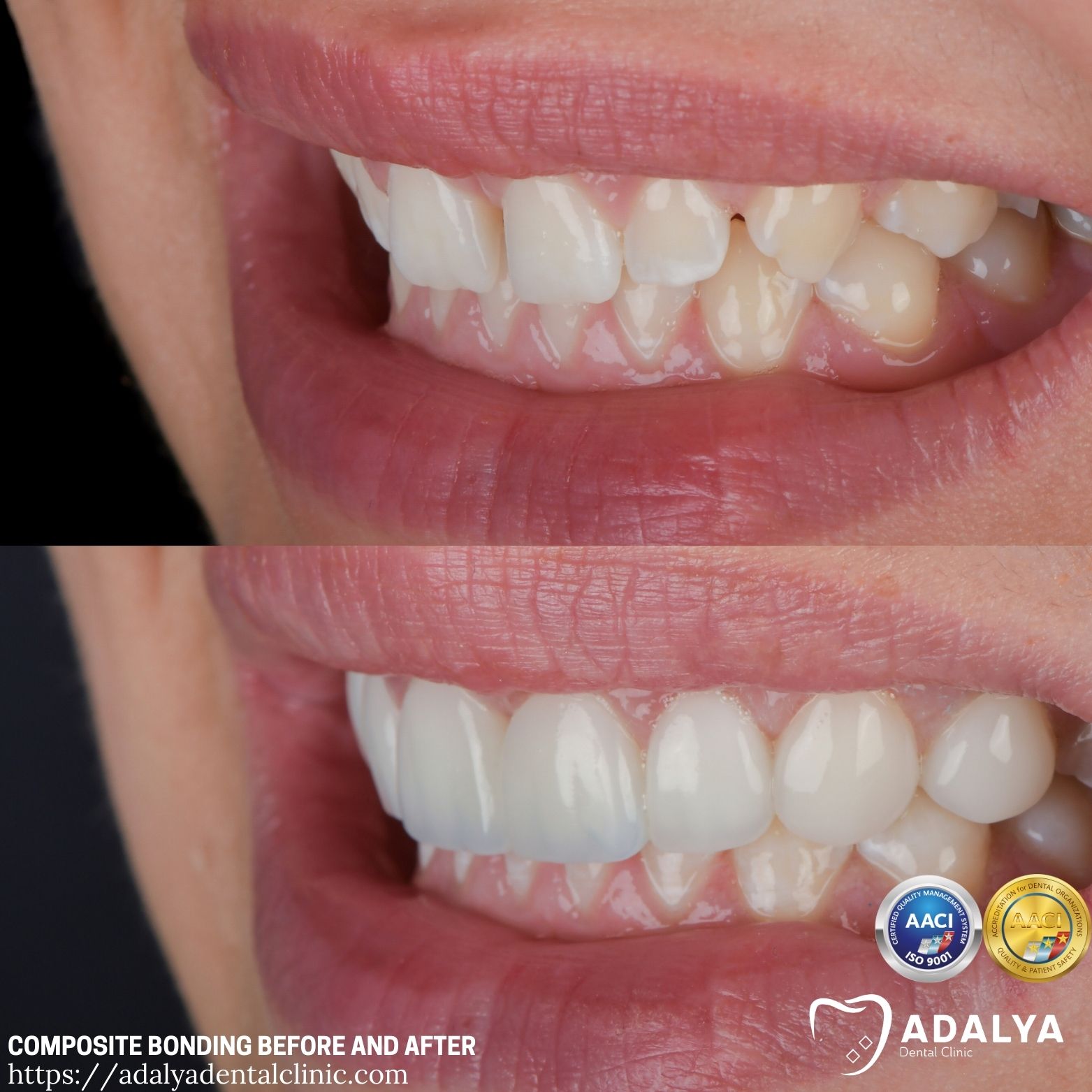 the uk teeth bonding before and after