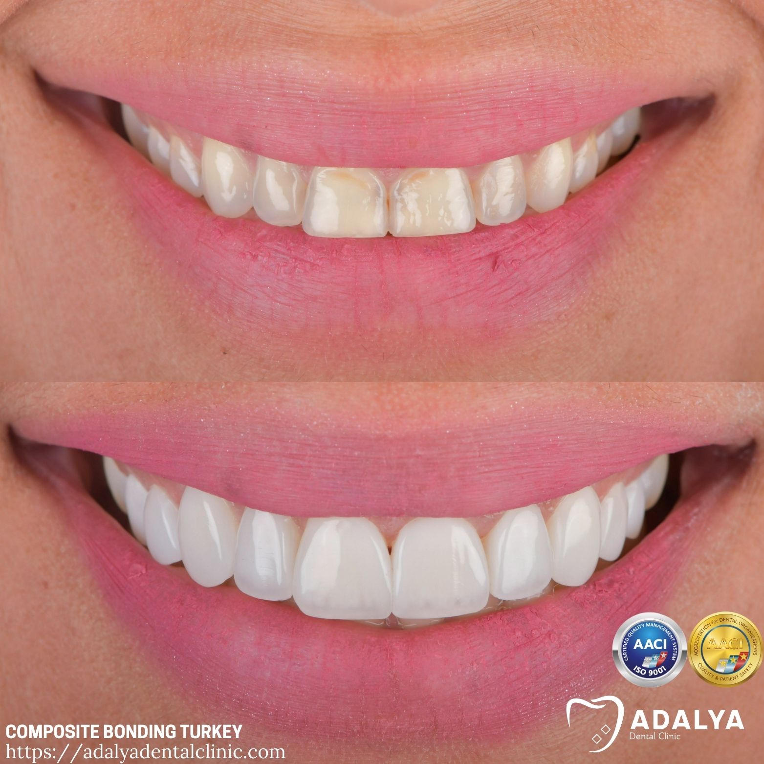 uk composite bonding before and after