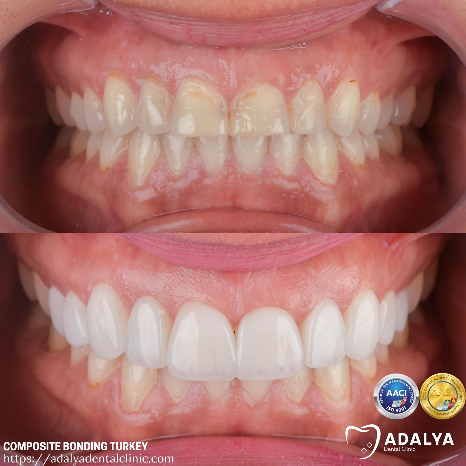 united kingdom composite bonding before and after
