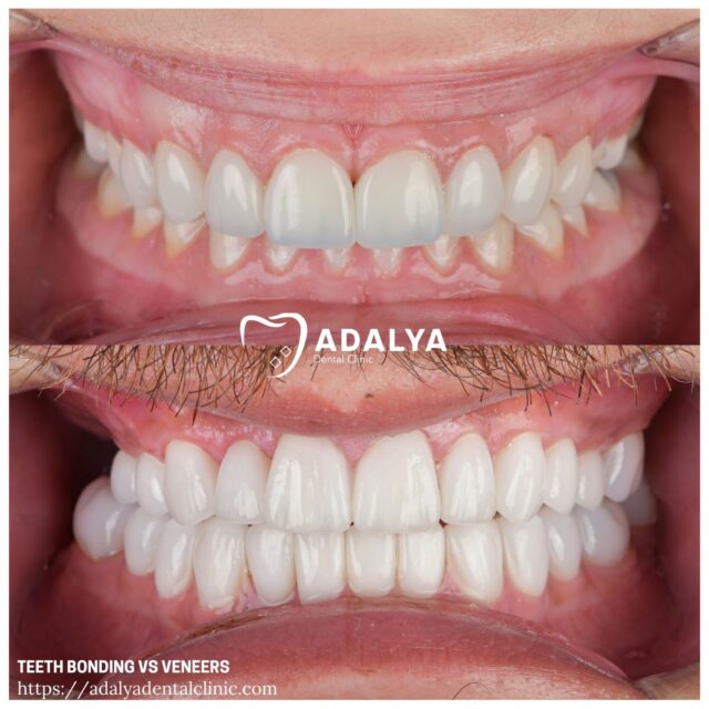 teeth bondıng vs veneers