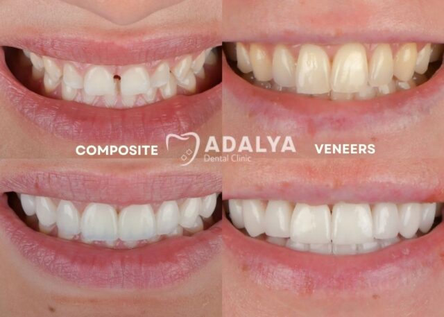 Composite Bonding vs Veneers: Key Differences For Teeth