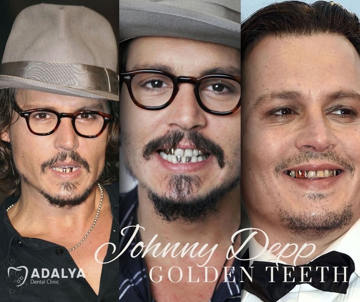 golden teeth of depp