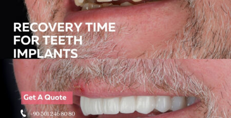 recovery time for teeth implants