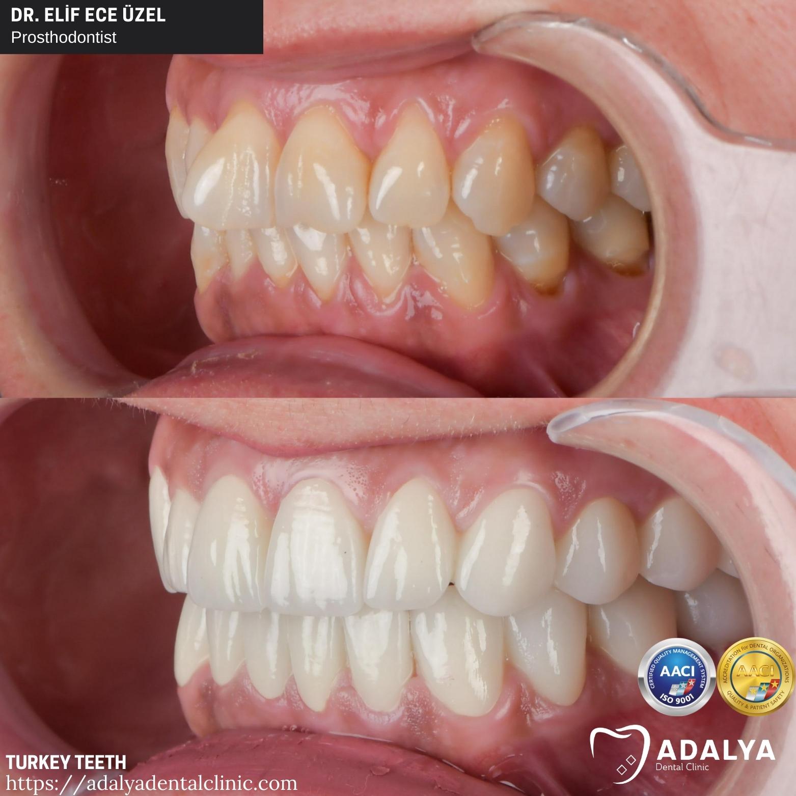 advantage-dental-treatments-in-turkey advantage dental treatments in turkey