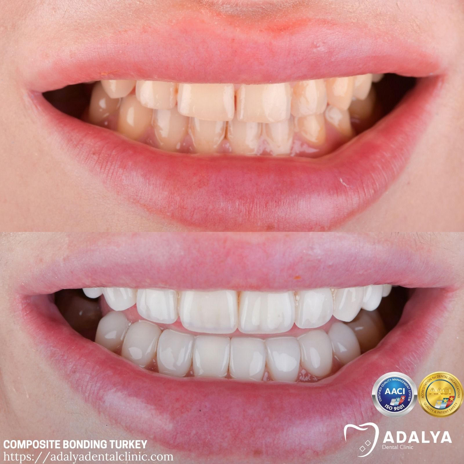 advantages of teeth bonding