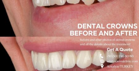 dental crowns before and after