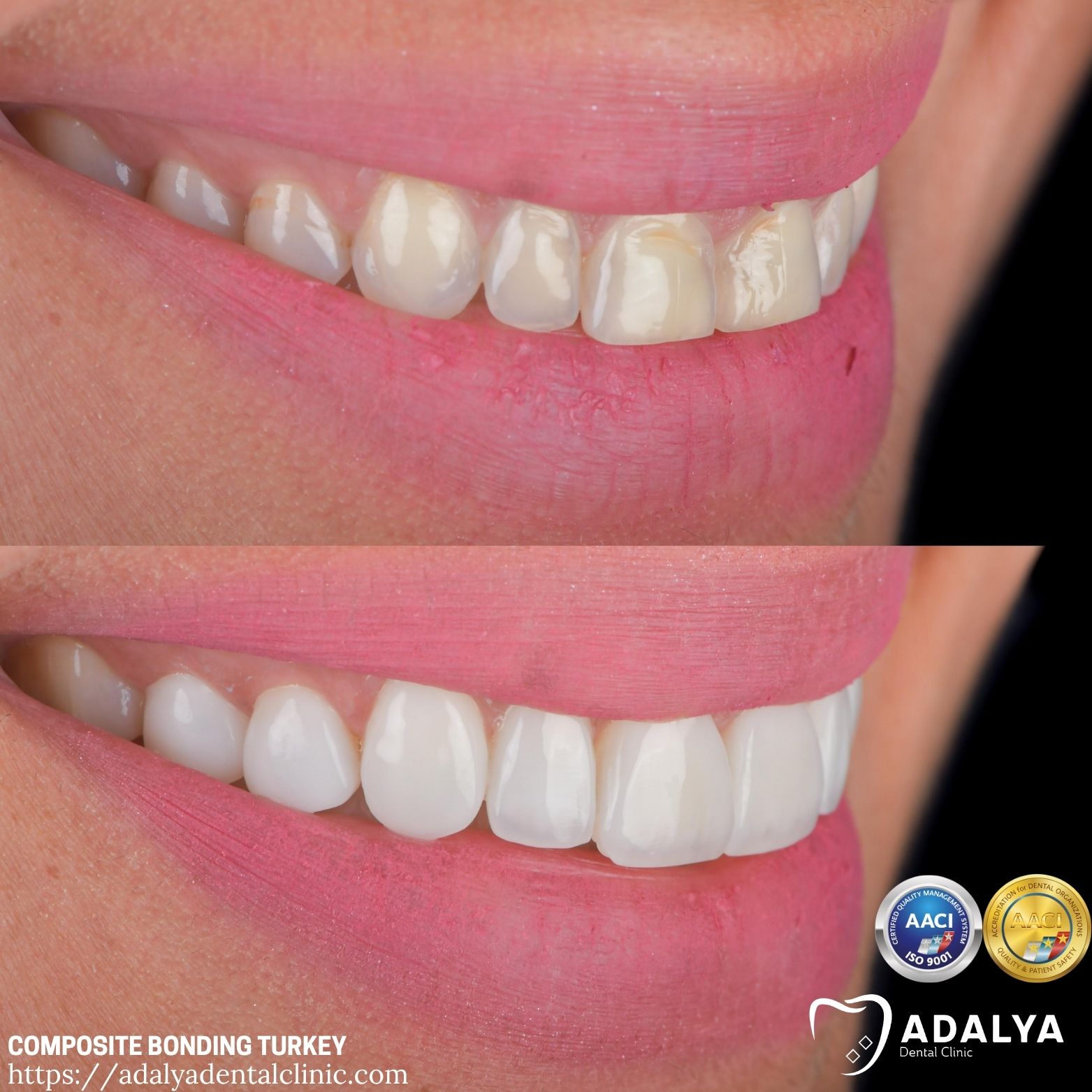 disadvantages of teeth bonding