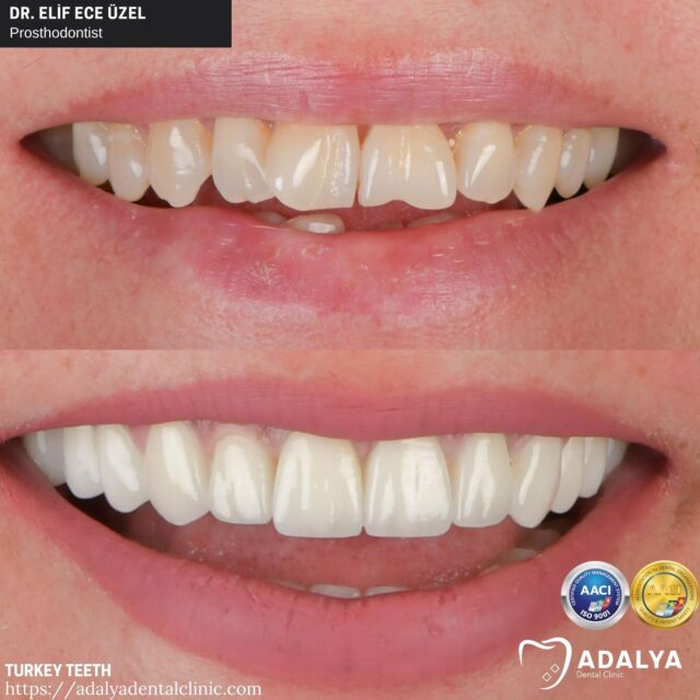 turkey-teeth-costs turkey teeth costs