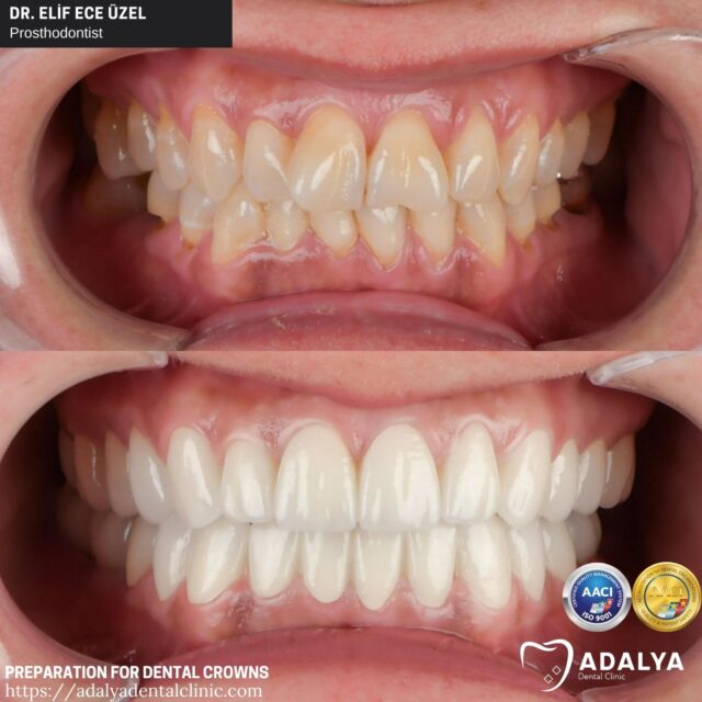 crown tooth preparation