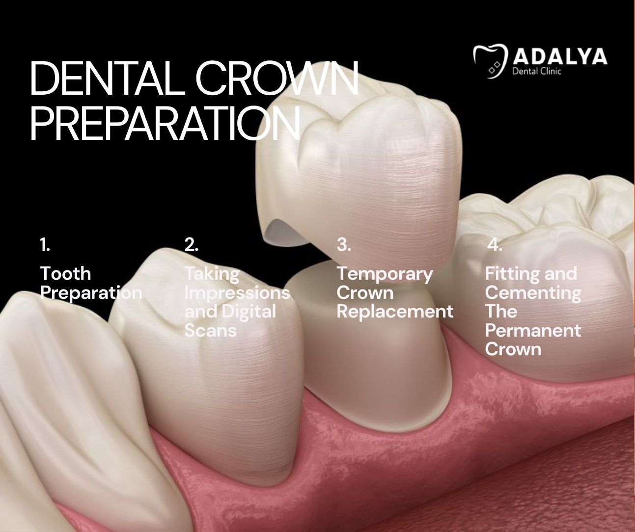 Dental Crown Preparation Steps For Crown Tooth Preparation