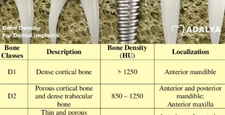 bone density for dental implants