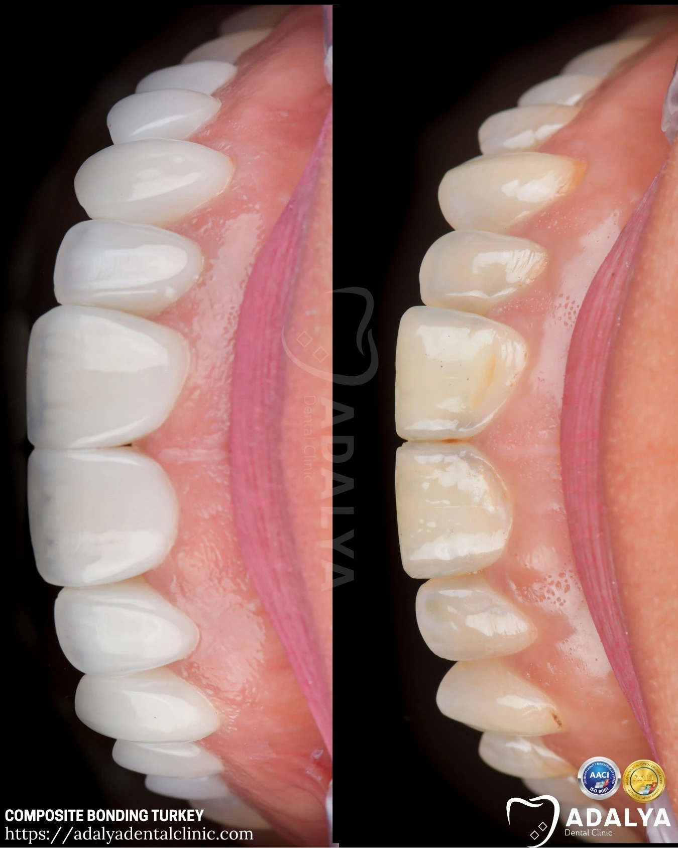 composite-resin-bonding-turkey composite resin bonding turkey