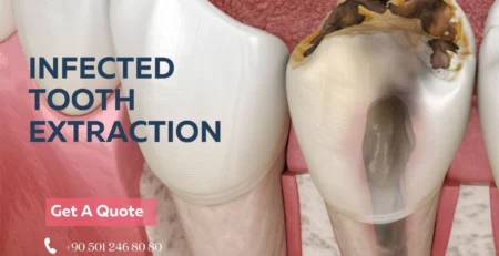 infected tooth extraction