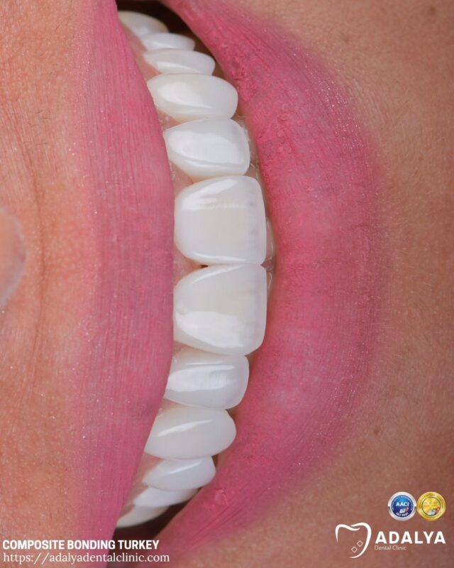 turkey-composite-bonding-teeth-price turkey composite bonding teeth price