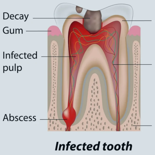what does an infected tooth look like