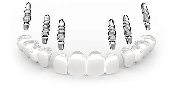3 on 6 teeth implants
