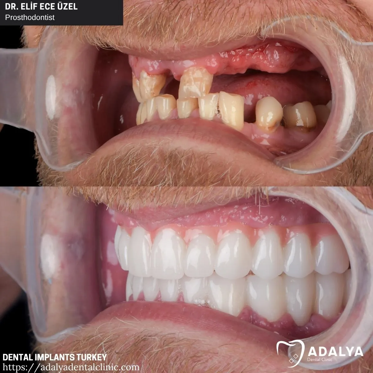 advantages of gettin teeth implants in turkey