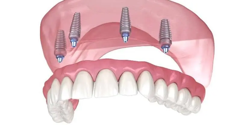 all on 4 implant