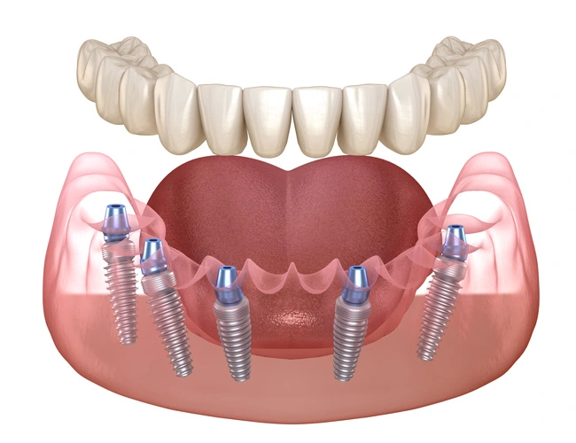all on 5 dental implant