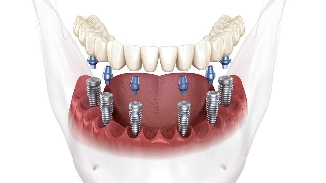 all on 6 tooth implant