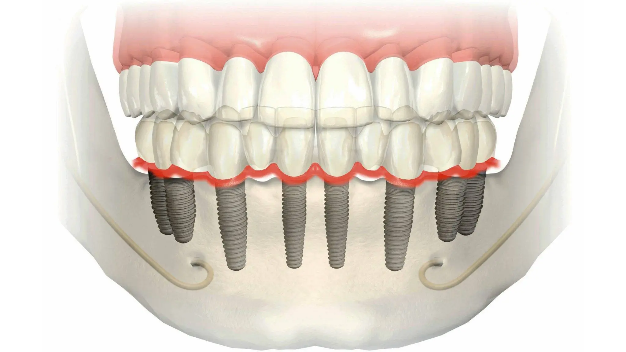all on 8 tooth implant