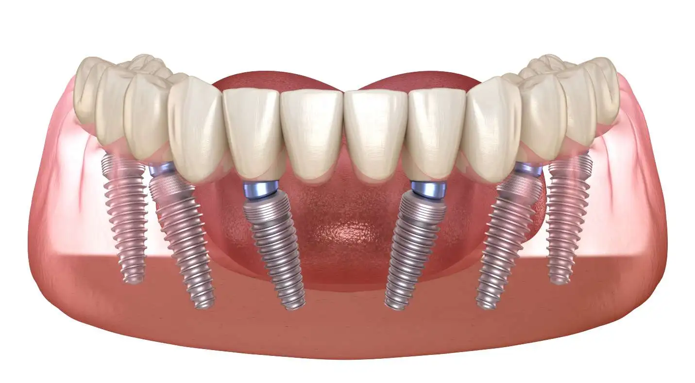 all on six teeth implants