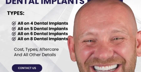 all on x dental implants