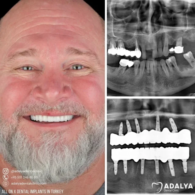 all on x teeth implants